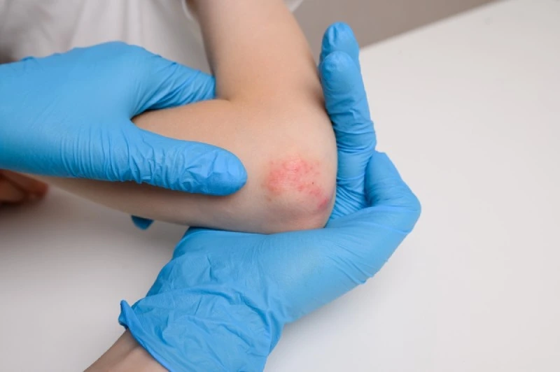 Eczema