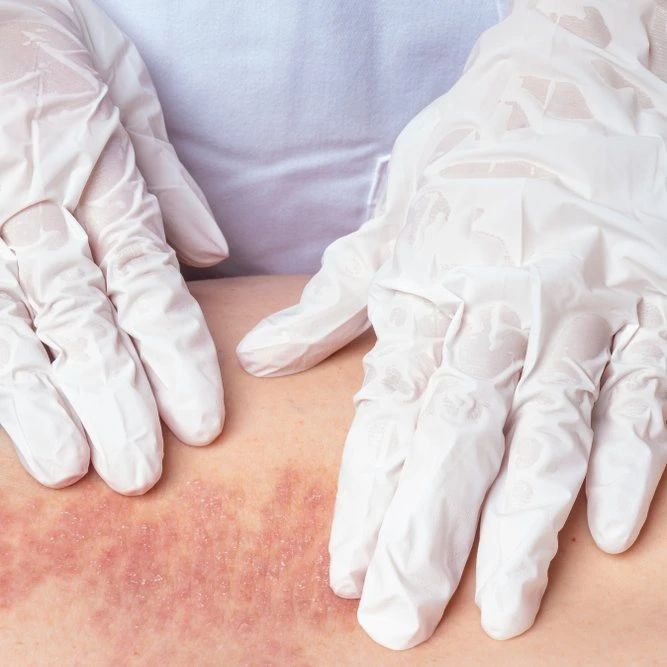 Psoriasis