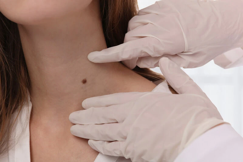 Skin Tag Removal