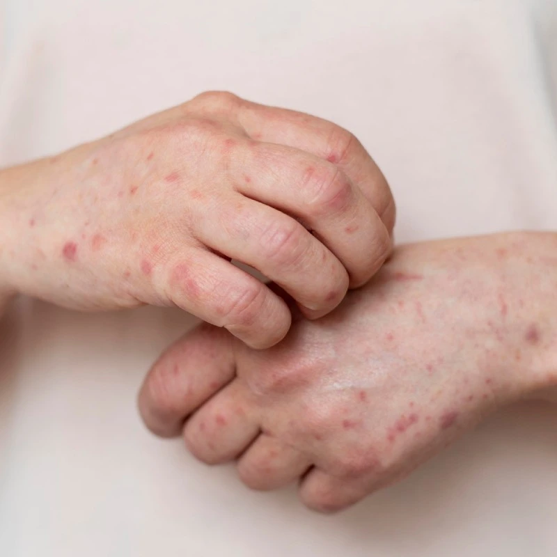 skin infection
